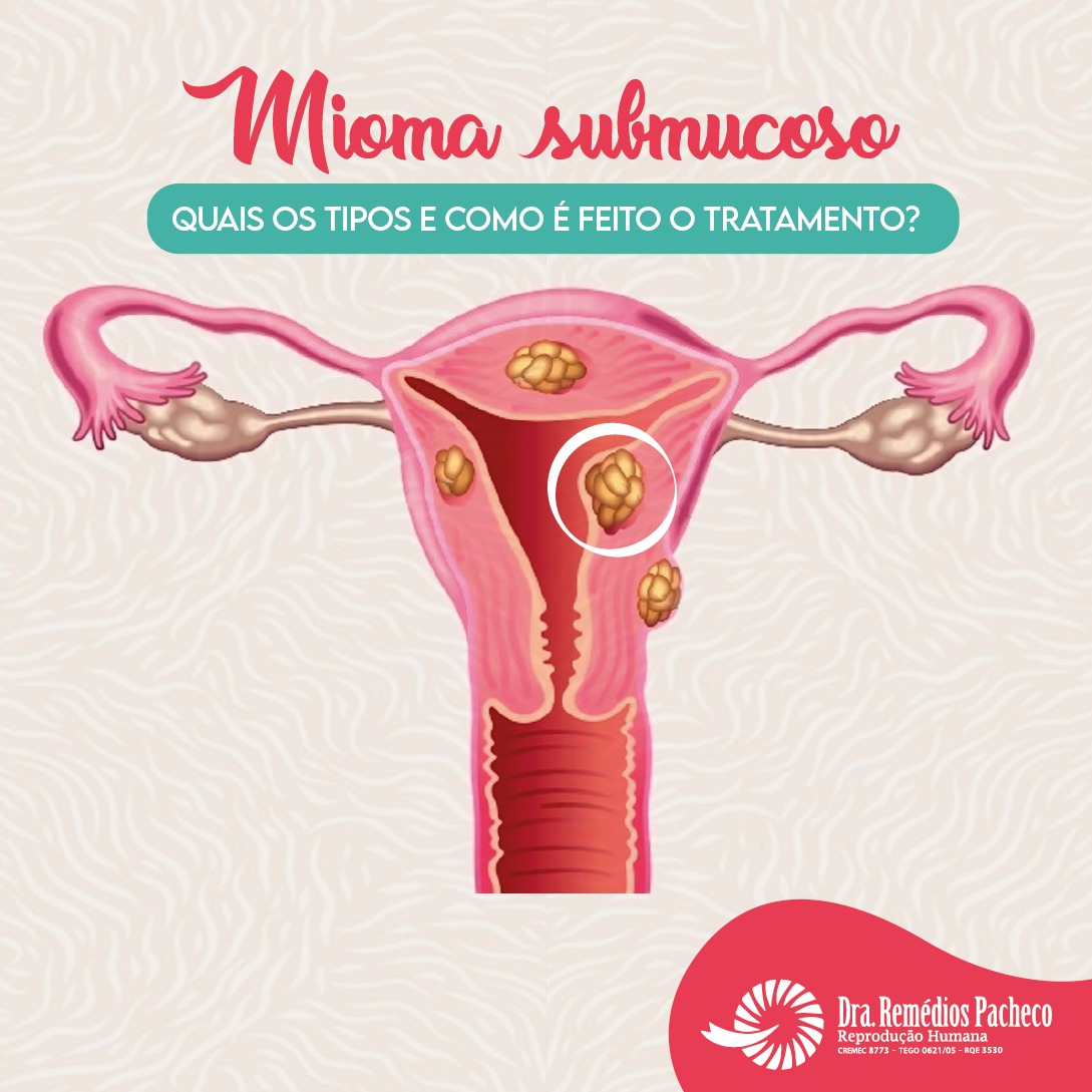 Mioma submucoso | Dra. Remédios Pacheco - Reprodução Humana | (85) 3031 ...